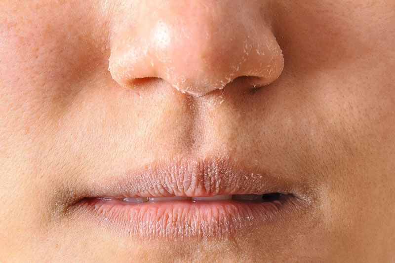 5 TIPS Chăm sóc da nhạy cảm mùa hanh khô đúng cách, hiệu quả