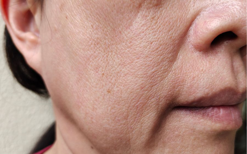 Da mặt nhăn nheo phải làm sao? 3 Cách cải thiện hiệu quả