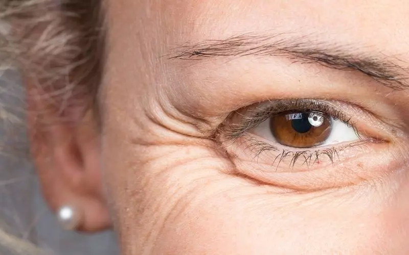 Da nhăn nheo là gì? 3 Cách cải thiện và phòng ngừa hiệu quả