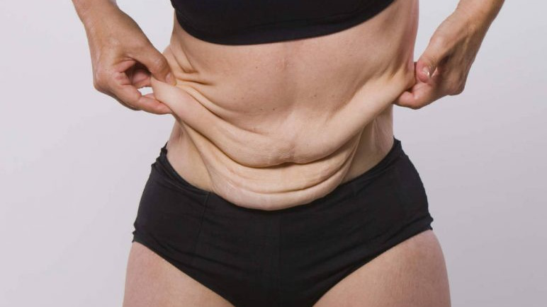 5 giải pháp phục hồi da nhăn nheo khi giảm cân đơn giản