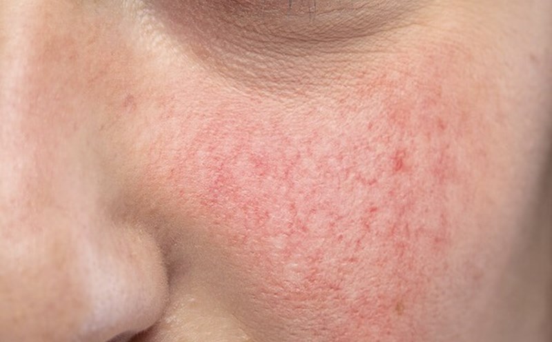 3 Cách chăm sóc da nhạy cảm khô căng đúng cách và an toàn