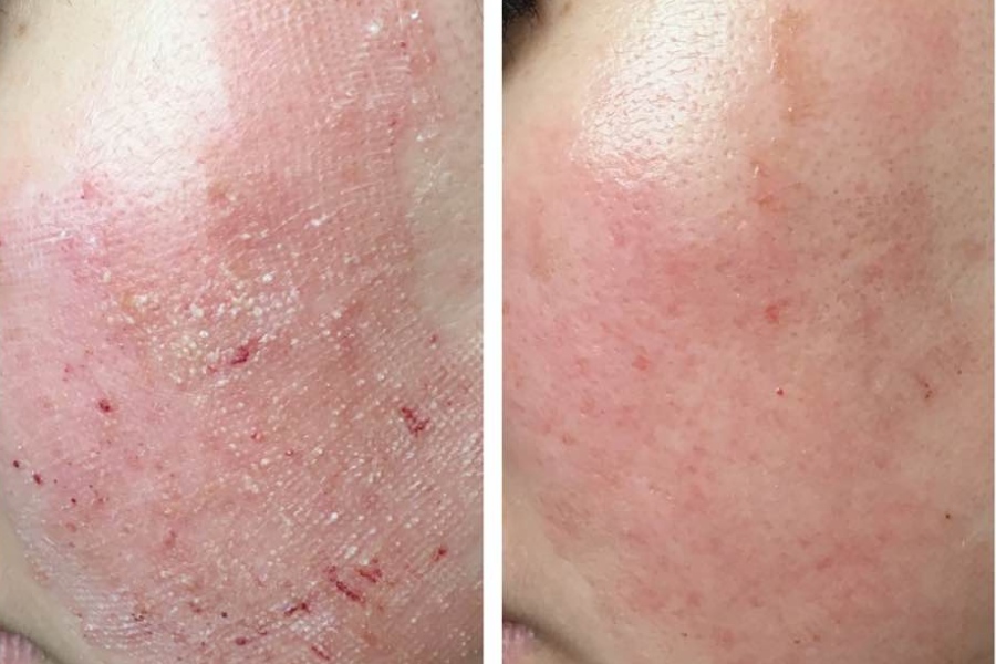 Da Nhạy Cảm Sau Laser: 3 Cách Chăm Sóc Và Phục Hồi Nhanh Chóng