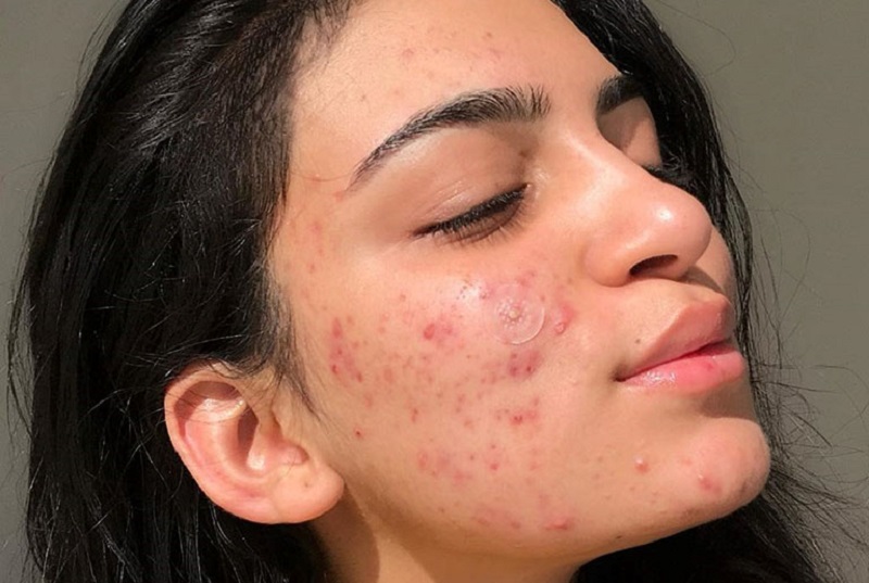 Đẩy mụn là gì? Nguyên nhân và 3 cách xử lý đẩy mụn đúng cách