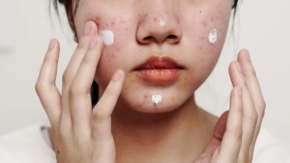 Kem chống nắng nào không kích ứng da: 2 Lựa chọn an toàn cho da nhạy cảm