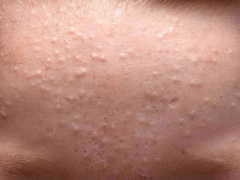 5+ Kem trị mụn cám tốt nhất hiện nay cho da sáng mịn