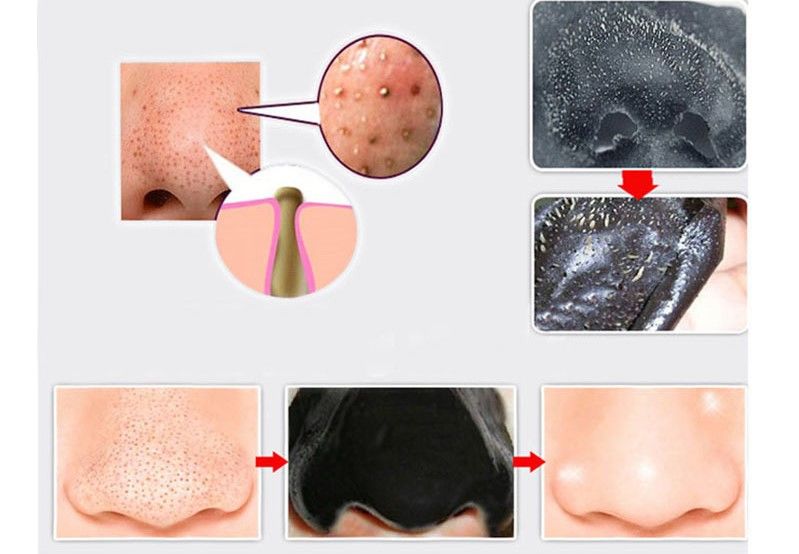3 Cách lột mụn cám hiệu quả và an toàn tại nhà