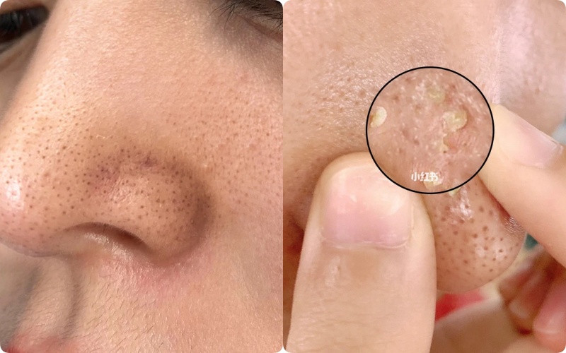 5 Cách trị mụn đầu đen hiệu quả và phòng ngừa tái phát