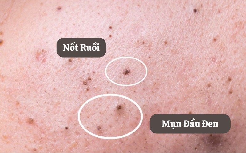 Mụn đầu đen không nặn thành nốt ruồi có nguy hiểm không?