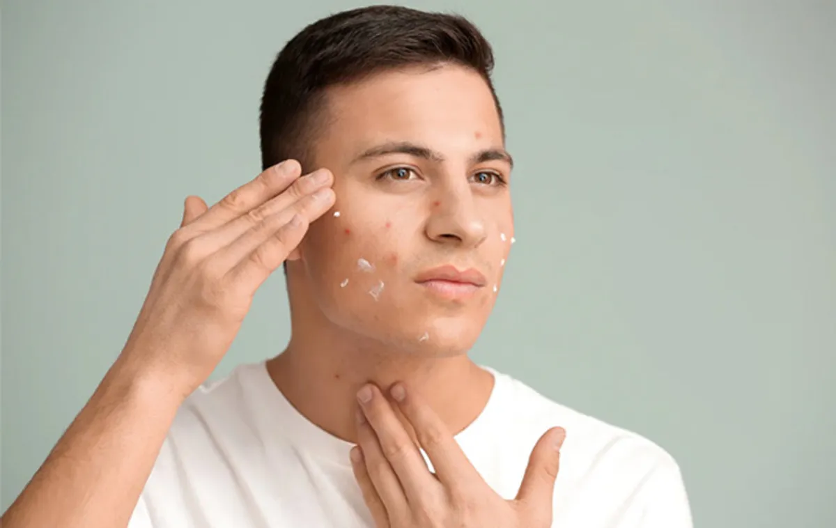 Mụn nội tiết nam: Nguyên nhân và 3 giải pháp điều trị hiệu quả