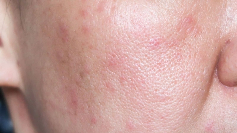 5 TIPS Skincare tối giản cho da nhạy cảm hiệu quả & an toàn