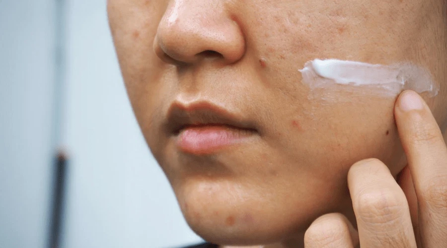 3+ Thuốc trị mụn nội tiết hiệu quả và an toàn từ chuyên gia