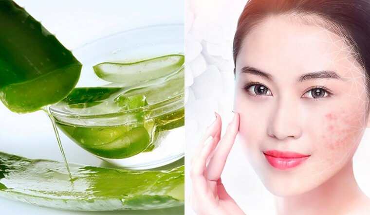 5 TIPS Trị mụn bằng nha đam an toàn và hiệu quả tại nhà