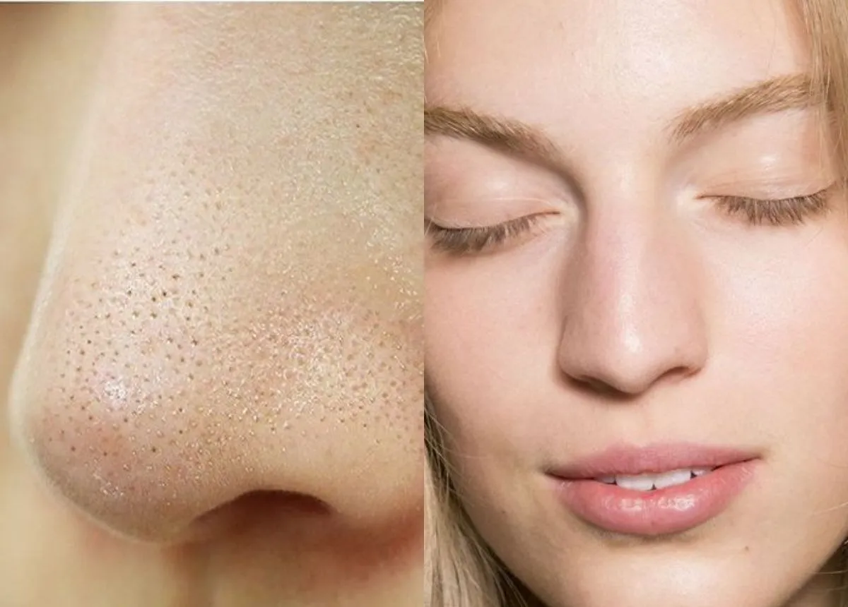 5+ Cách trị mụn cám ở mũi hiệu quả, an toàn, không tái phát