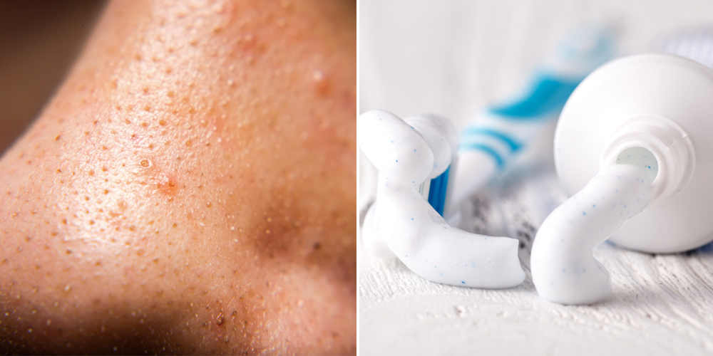 5 Cách trị mụn cám ở mũi bằng kem đánh răng hiệu quả