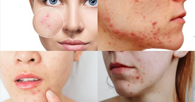 3 Phương pháp trị mụn nội tiết hiệu quả, an toàn và bền vững