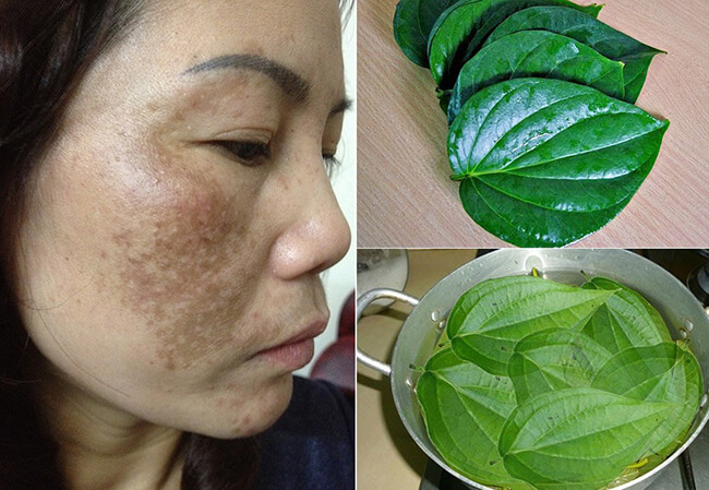 ̀5 TIPS Trị nám bằng lá trầu không an toàn, hiệu quả ngay tại nhà