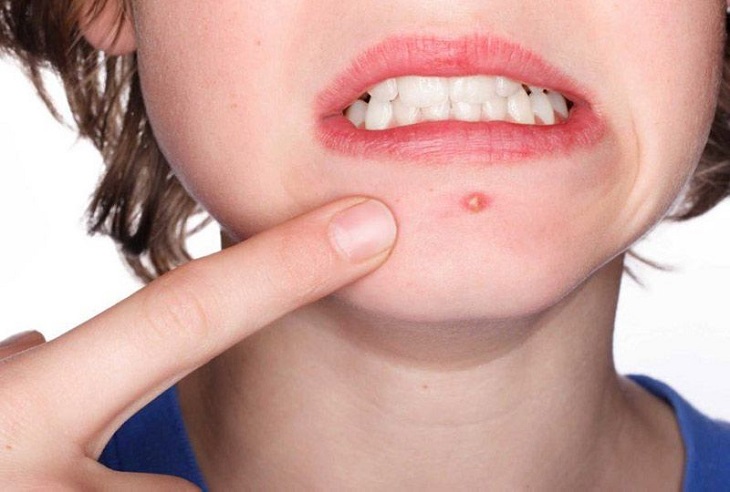 Bị mụn bọc nên ăn gì để cải thiện tình trạng mụn hiệu quả