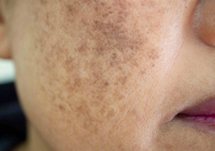 Hiểu rõ về tình trạng bị nám sau sinh và 3 cách chăm sóc da hiệu quả