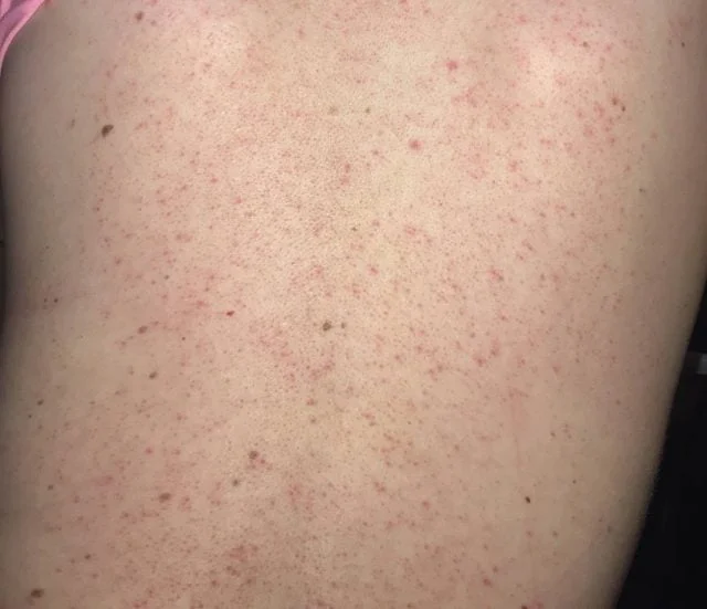 3 Cách phòng ngừa viêm nang lông hiệu quả cho làn da khỏe mạnh