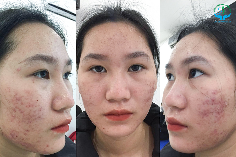 3 Cách trị mụn hiệu quả giúp bạn lấy lại làn da sạch khỏe tự tin