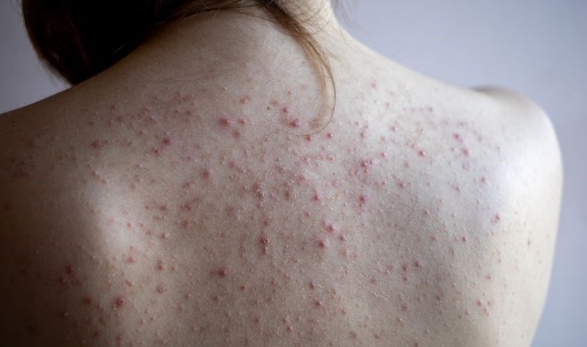 3 Cách trị mụn lưng cho bà bầu tại nhà an toàn và hiệu quả