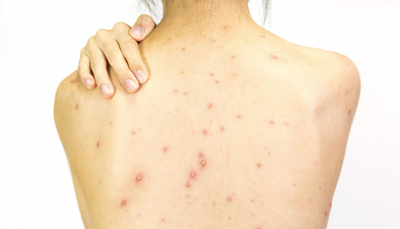 5+ Cách trị mụn lưng ở tuổi dậy thì hiệu quả và an toàn