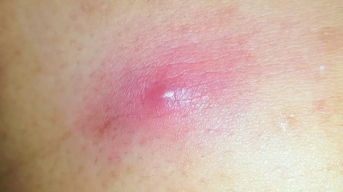 3 Cách trị mụn nhọt ở mông hiệu quả và an toàn cho làn da