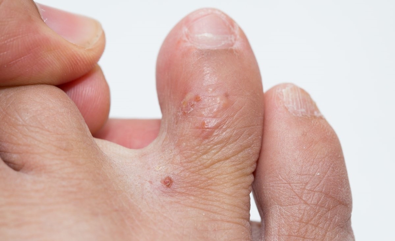 3 cách trị mụn nước ở chân tại nhà nhanh chóng và an toàn