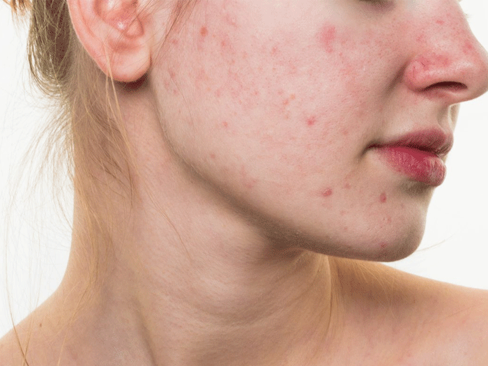 3 TIPS Chăm sóc da mụn khi giao mùa hiệu quả