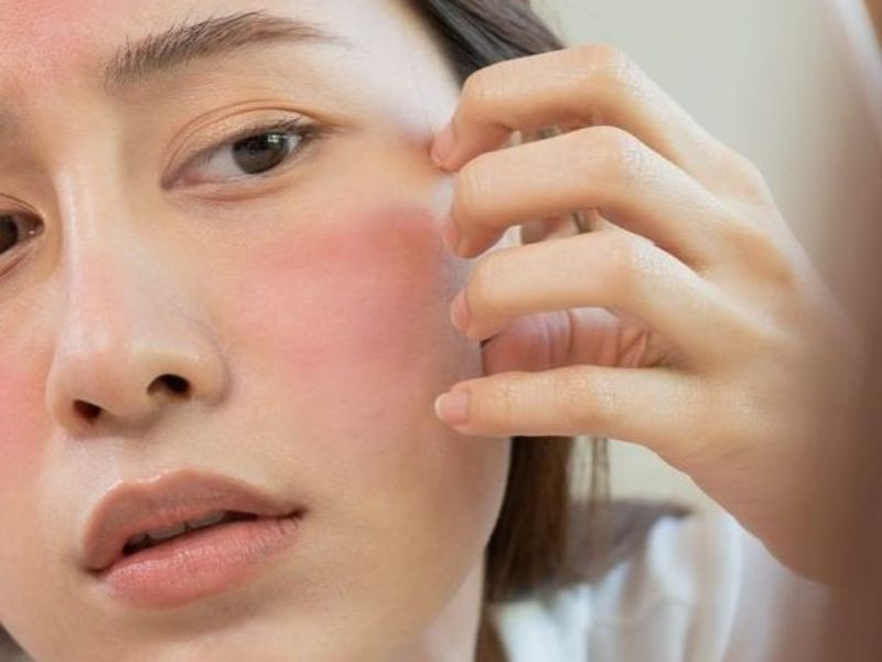 3 cách chăm sóc da đỏ rát khi giao mùa hiệu quả