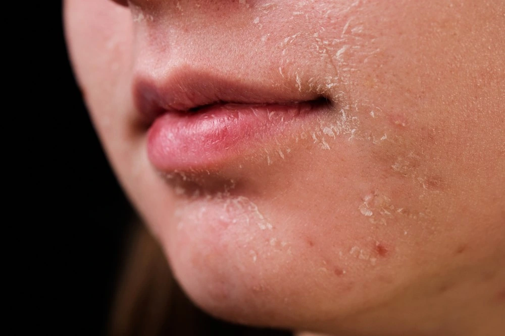 5 Cách chăm sóc da khô bong tróc mùa thu hiệu quả