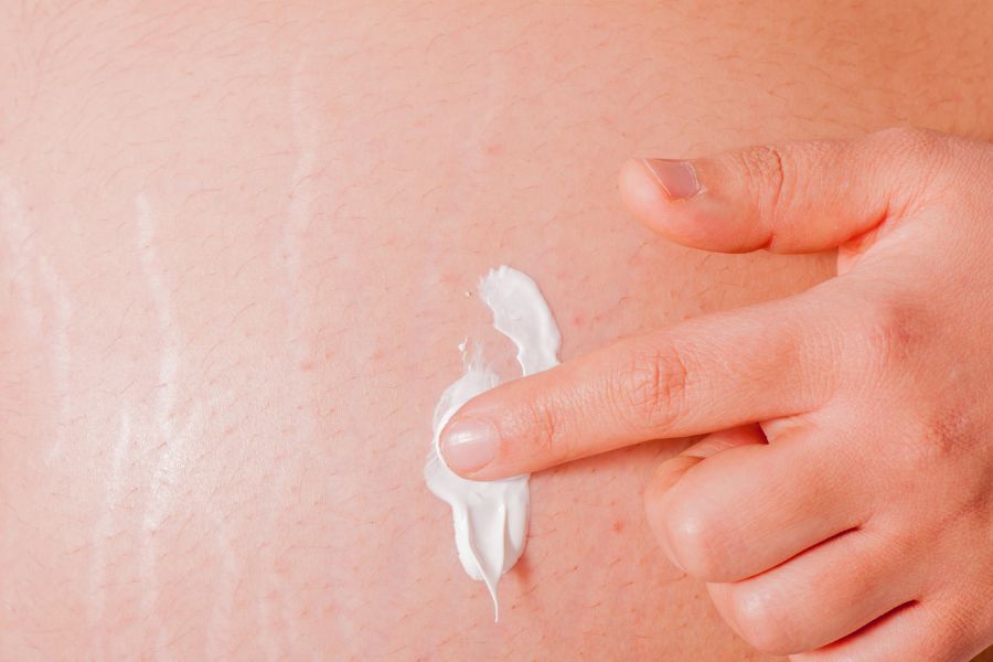 3+ Kem trị viêm nang lông hiệu quả cho làn da mịn màng