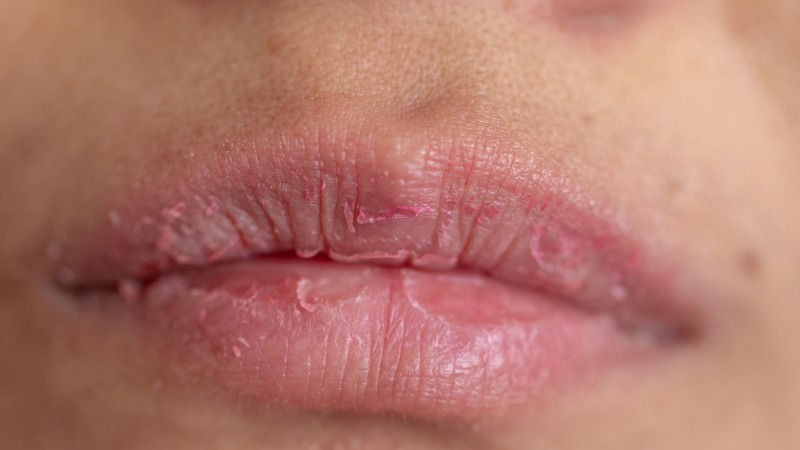 5 TIPS Chăm sóc môi khô nứt mùa thu thành căng mọng