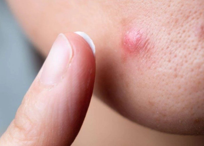 3 Cách làm xẹp mụn bọc ở má hiệu quả