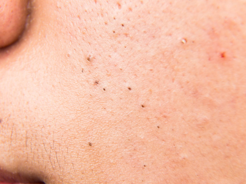 Mụn đầu đen – Nguyên nhân và 3 cách chăm sóc da hiệu quả