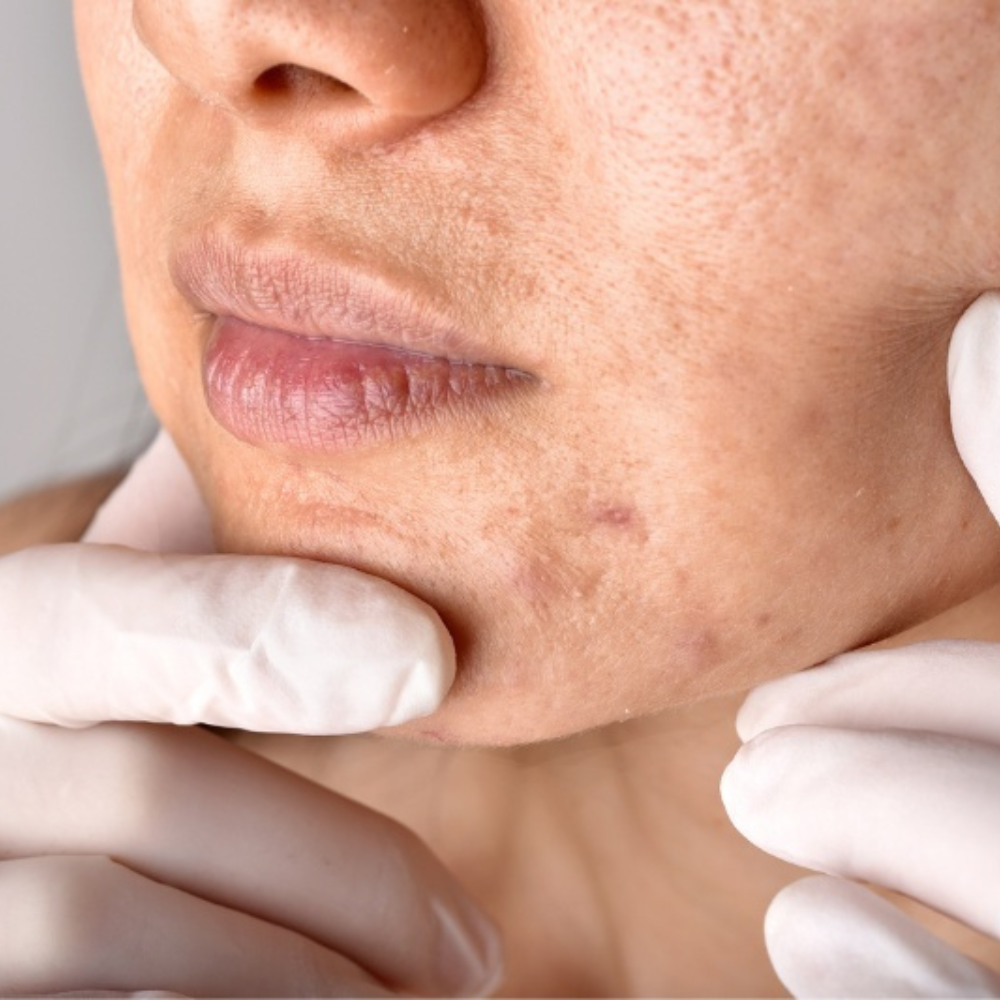 3 Bước Làm Mờ Mụn Thâm Đen Để Có Làn Da Khỏe Mạnh