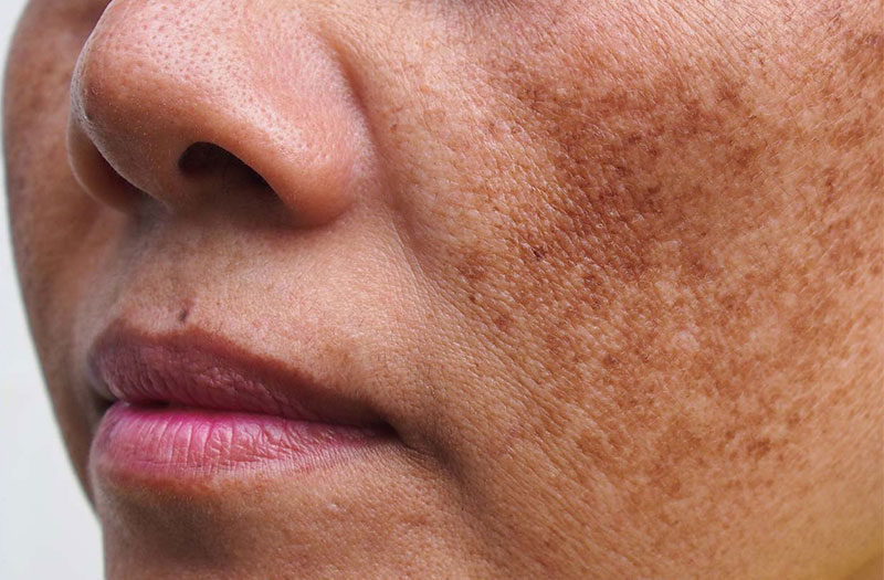 Nám mảng là gì? 3 Bí quyết đẩy lùi nám mảng hiệu quả