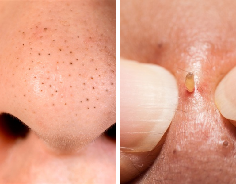 3 TIPS Nặn Mụn Đầu Đen Ở Mũi An Toàn và Hiệu Quả