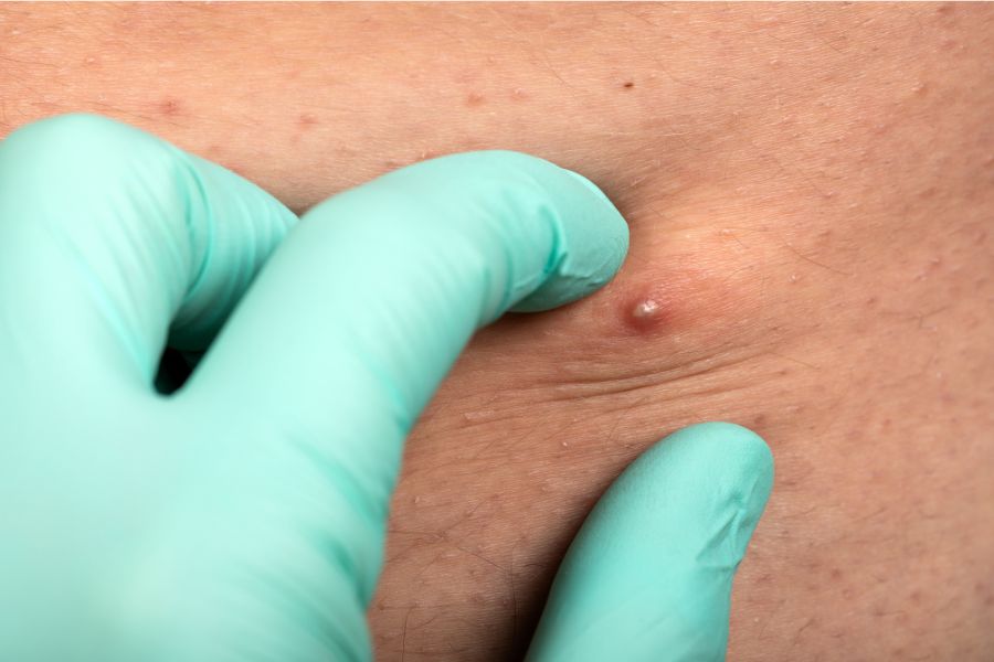 3+ Thuốc bôi viêm nang lông vùng kín hiệu quả