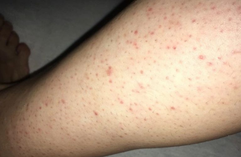 3 Cách trị viêm nang lông ở chân hiệu quả ngay tại nhà