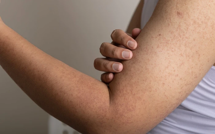 Viêm nang lông cánh tay và 3 cách chăm sóc hiệu quả