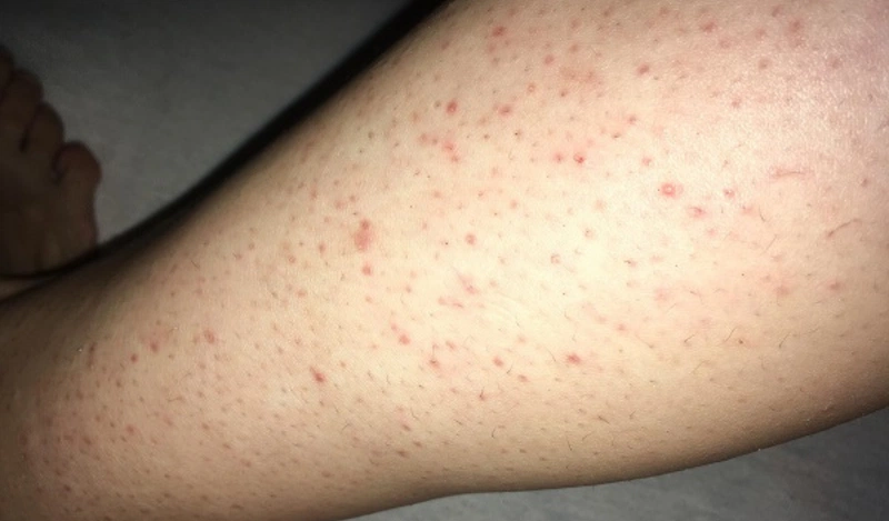 Hiểu Về Viêm Nang Lông Chân Và 3 Cách Phòng Ngừa Hiệu Quả