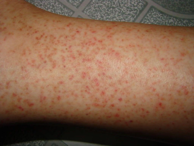 Tìm hiểu về viêm nang lông hồng ban hình mạng lưới