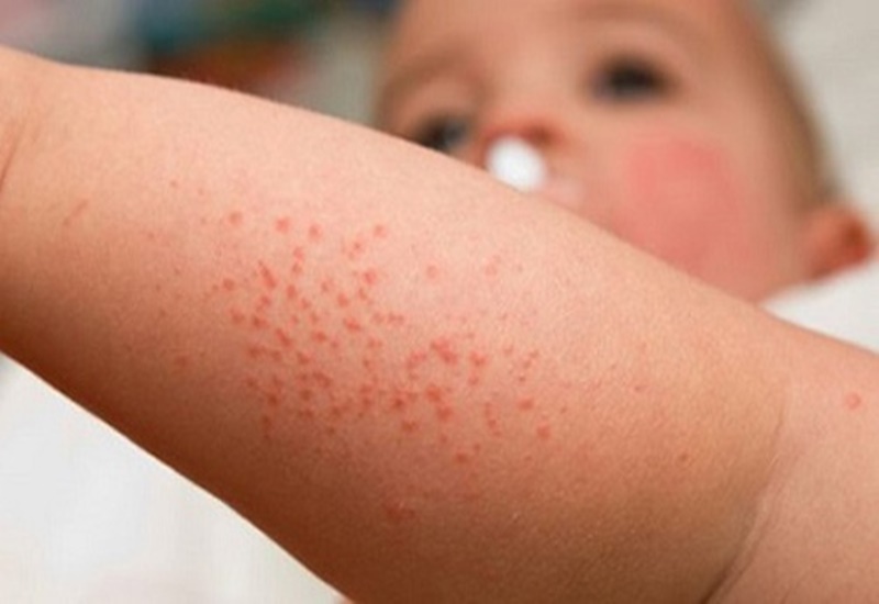 Viêm Nang Lông Ở Trẻ Em: Nhận Biết Và 3 Cách Chăm Sóc Hiệu Quả