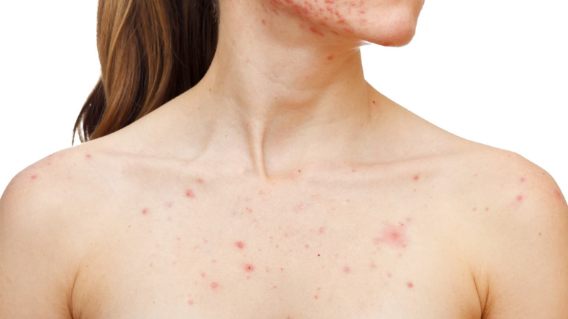 3 cách phòng tránh viêm nang lông hiệu quả