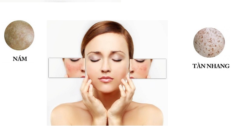 3+ viên uống trị nám da tốt nhất cho làn da sáng mịn