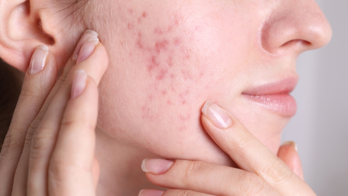 Xu hướng chăm da phục hồi sau mụn hiện nay hiệu quả nhất 2025