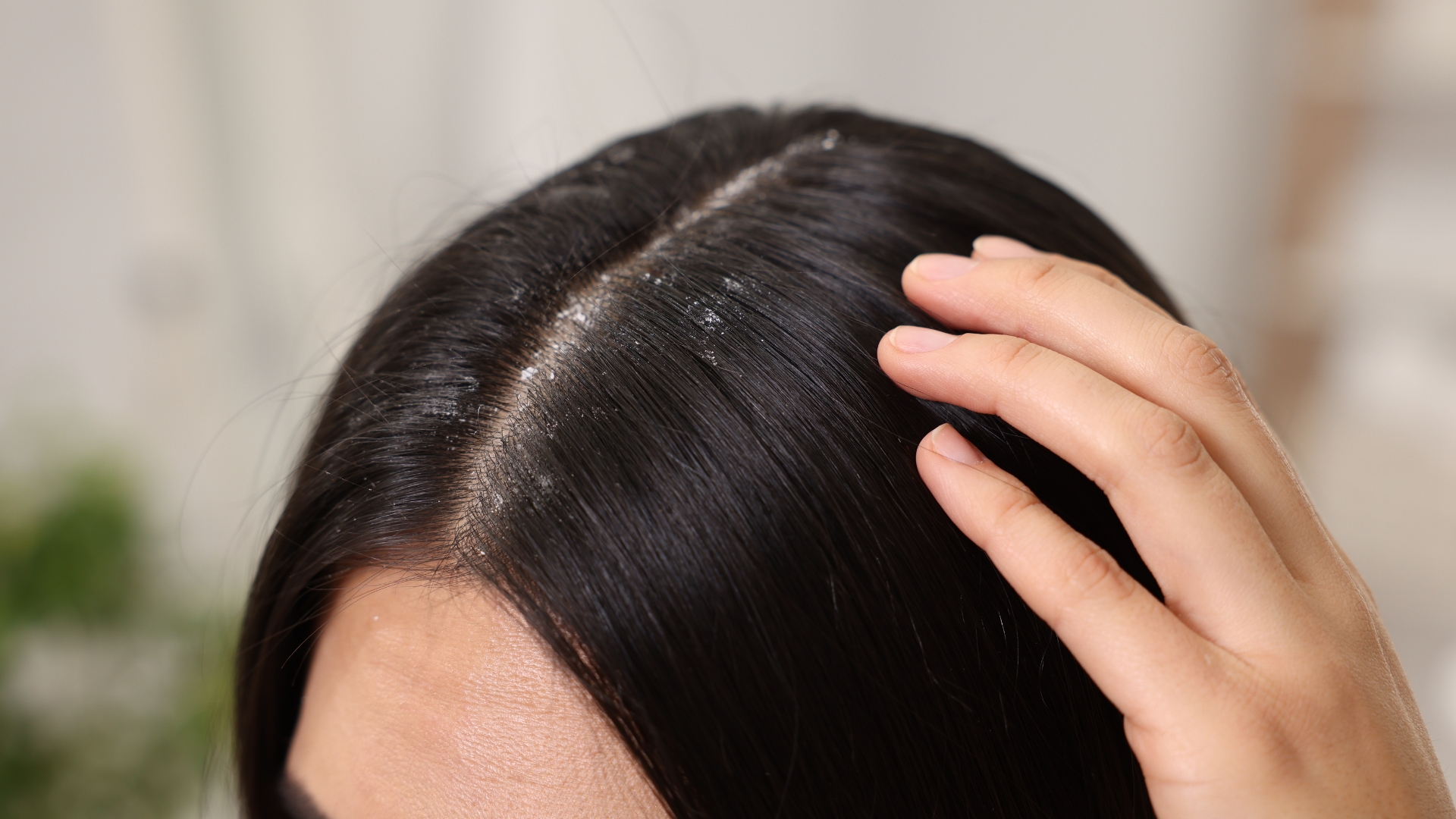 5 cách trị gàu và ngứa da đầu hiệu quả nhất hiện nay