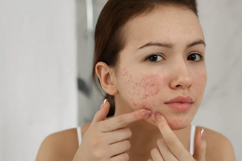 5 Quy trình skincare cho da dầu mụn an toàn và hiệu quả nhất